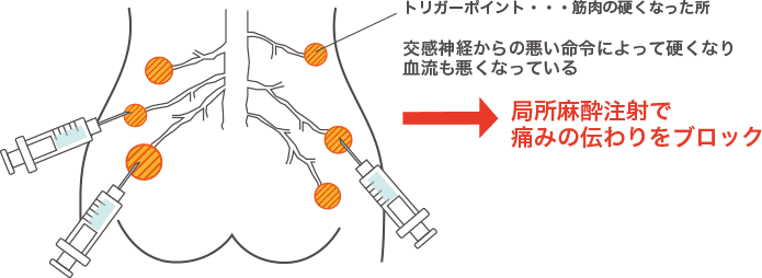 局所麻酔駐車で痛みの伝わりをブロック