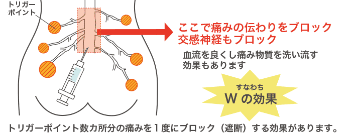 トリガーポイント数カ所分の痛みを一度にブロック(遮断)する効果があります。